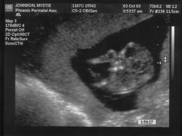 10/03/03

12 weeks 3 days

Side view of face and hand.