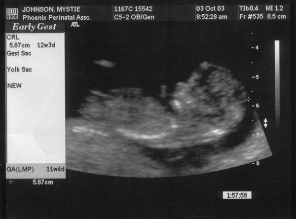 10/03/03

12 weeks 3 days

Side view of face and body