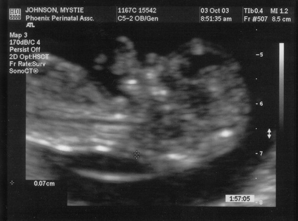 10/03/03

12 weeks 3 days

Close up of face and chest - Side veiw.
